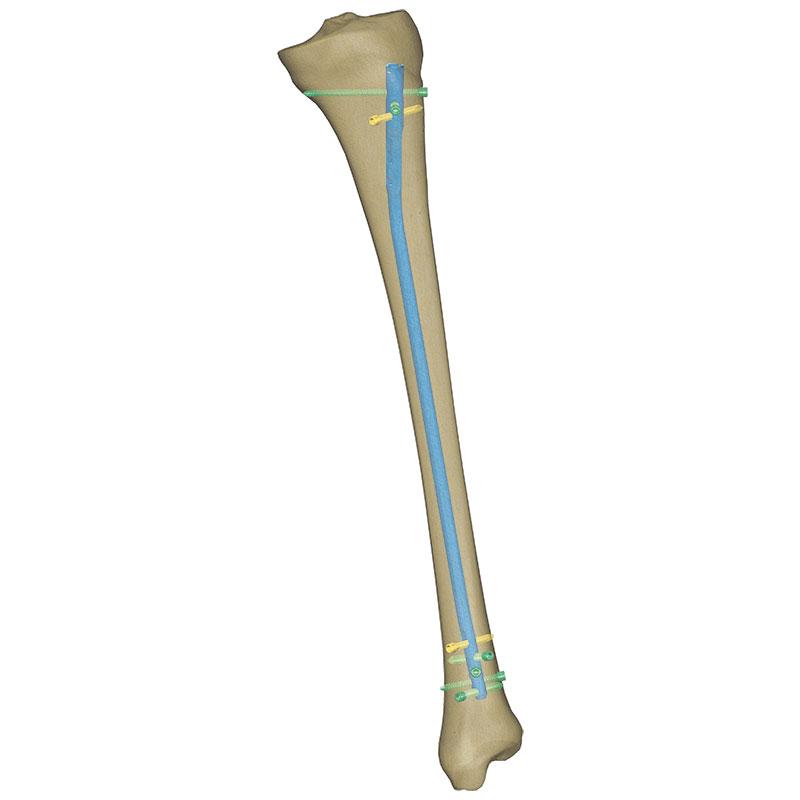 Стержень для інтрамедулярного остеосинтезу великогомілкової кістки Charfix